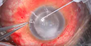 Refractory Pupillary Block