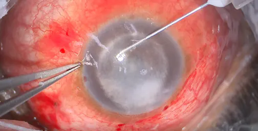Refractory Pupillary Block