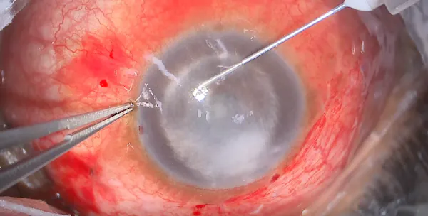 Refractory Pupillary Block thumbnail