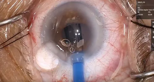 Preloaded IOL Inserter in Case of Small Pupil