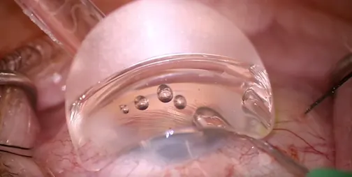 Interventional Glaucoma: Using Multiple Technologies
