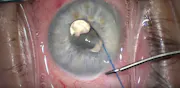 Incorporating Home Tonometry