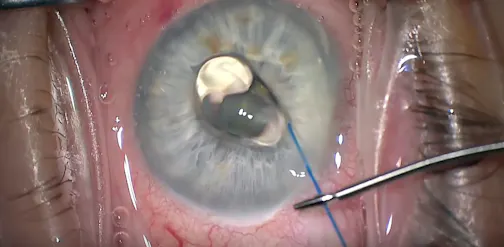 Incorporating Home Tonometry