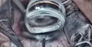iDose TR Procedure
