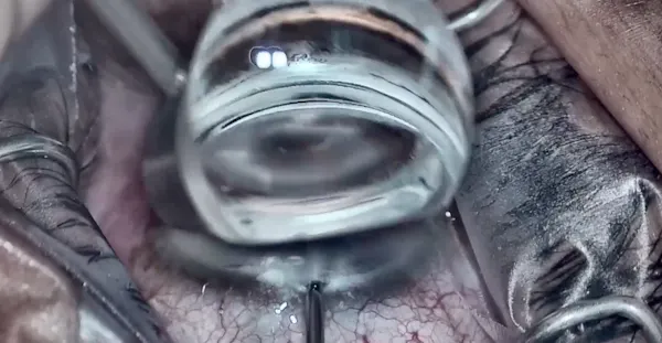 iDose TR Procedure thumbnail