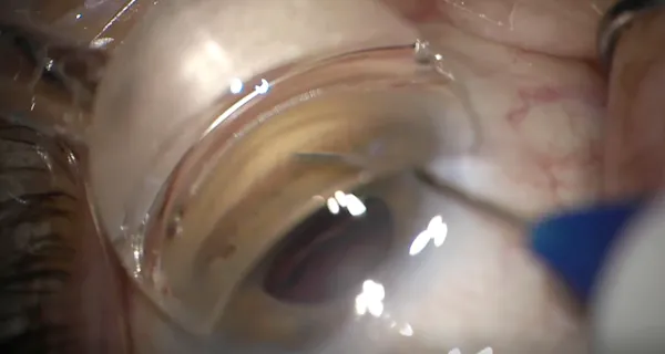 Shear Thinning and Collector Channels thumbnail