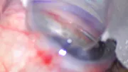 Viscodilation and Goniotomy With iTrack