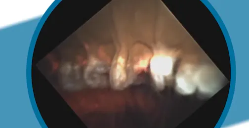 Endoscopic Cyclophotocoagulation