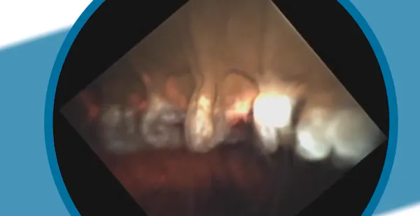 Endoscopic Cyclophotocoagulation thumbnail