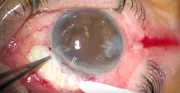 Preserflo Microshunt