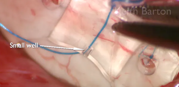 Paul Implant thumbnail