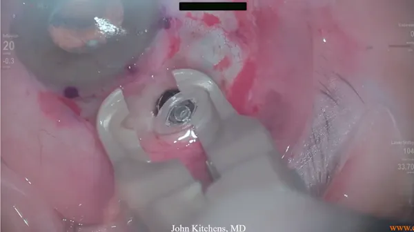 Contivue: Surgical Pearls and Tricks thumbnail