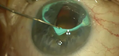 I-Ring Small Pupil Management