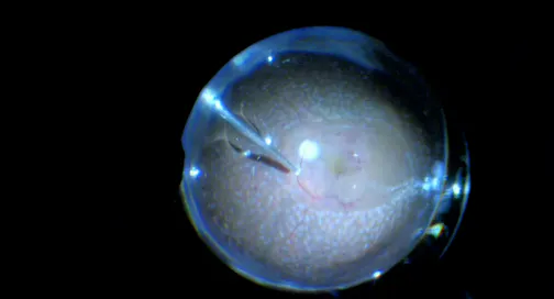 PDR With Recurrent Vitreous Hemorrhage
