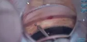 iStent Infinite Placement With Hands-Free Gonio Lens Using Ngenuity and ScopeXR