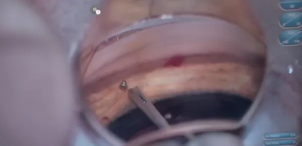 iStent Infinite Placement With Hands-Free Gonio Lens Using NGenuity and ScopeXR thumbnail