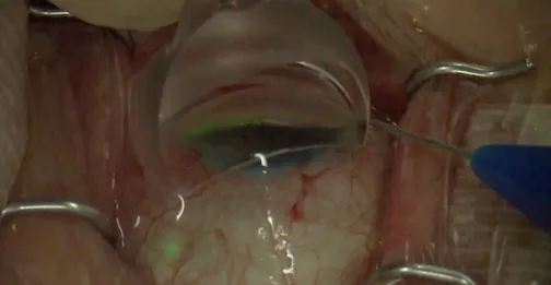 iTrack Advance: Collector Channel Intubation
