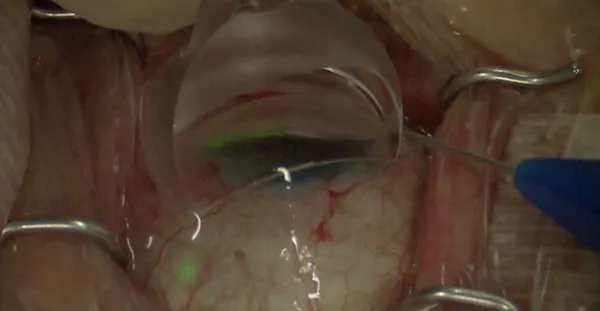 iTrack Advance: Collector Channel Intubation thumbnail