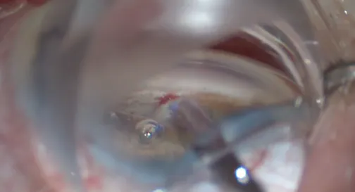 AlloFlo Cleft Creation Troubleshooting: Viscocycloplasty