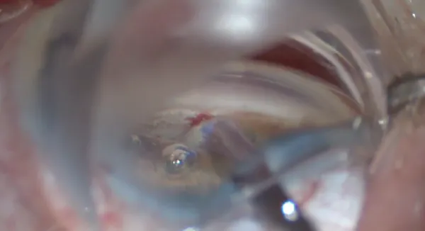 AlloFlo Cleft Creation Troubleshooting: Viscocycloplasty thumbnail