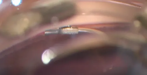 Cataract Surgery and Hydrus Implantation