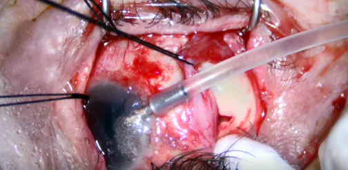 Hemorrhagic Choroidals After Combined Phaco-Trabeculectomy