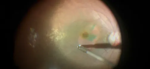 Petaloid Self-Coiling ILM Covering Technique for Macular Hole Repair