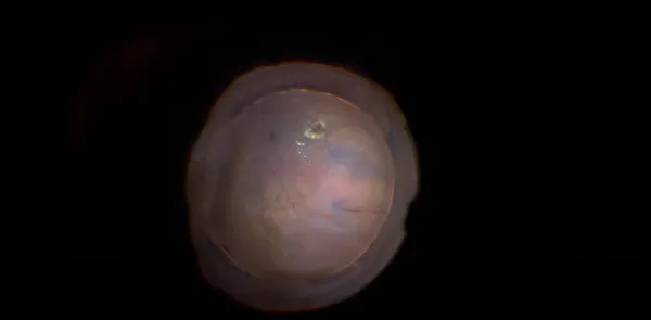 Retinal Detachment Repair Assisted by Subretinal Staining thumbnail