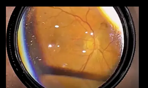 Combined Scleral Buckle and Vitrectomy for Pseudophakic Retinal Detachment