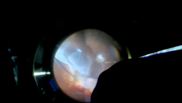 Sub-silicone Retinal Detachment With Submacular Bands thumbnail