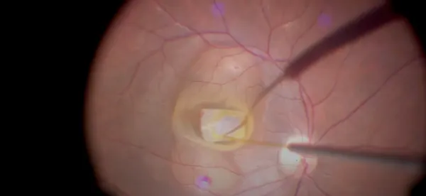 Surgery to Remove a Previously Implanted Human Amniotic Membrane and Repair a Refractory Macular Hole thumbnail