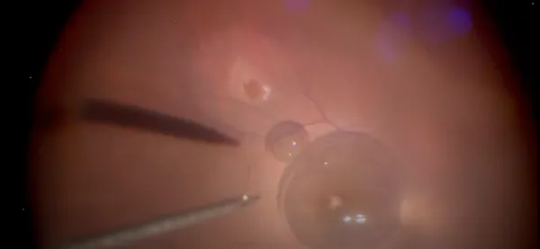 Autologous Retinal Transplantation for Macular Hole Repair thumbnail