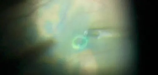Petal-Shaped ILM Self-Rolling Technique for Complex Secondary Macular Hole Repair