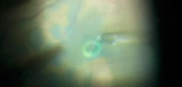 Petal-Shaped ILM Self-Rolling Technique for Complex Secondary Macular Hole Repair thumbnail