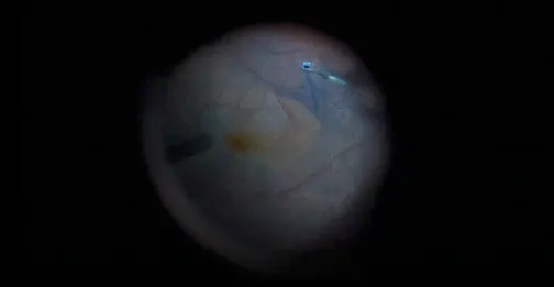 Combined Penetrating Keratoplasty and Vitrectomy for Macular Pucker