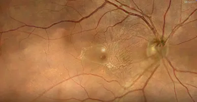 Enhanced Visual Recovery Following Vitrectomy for Symptomatic Macular Pucker thumbnail