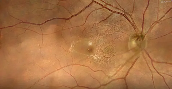 Enhanced Visual Recovery Following Vitrectomy for Symptomatic Macular Pucker thumbnail