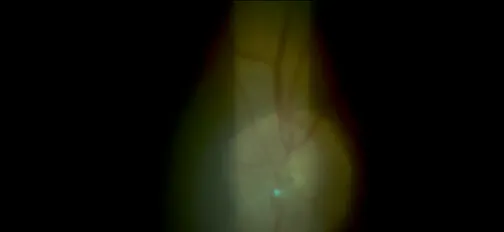 YAG Laser Embolysis