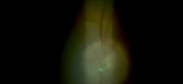 YAG Laser Embolysis thumbnail
