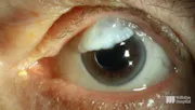 Overhanging Bleb Revision With Conjunctival Advancement