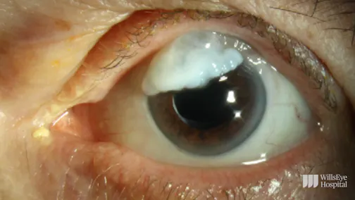 Overhanging Bleb Revision With Conjunctival Advancement