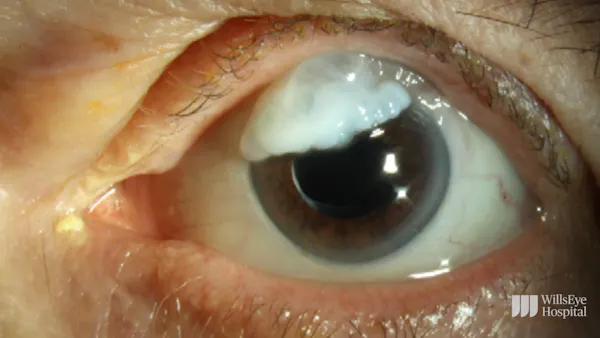 Overhanging Bleb Revision With Conjunctival Advancement thumbnail