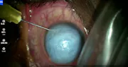 Down Syndrome With Keratoconus