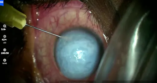 Down Syndrome With Keratoconus