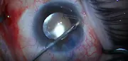 Uveitis With Glaucoma