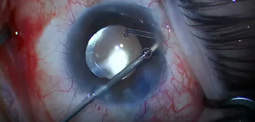 Uveitis With Glaucoma