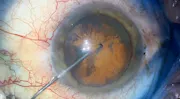 Intralenticular Foreign Body
