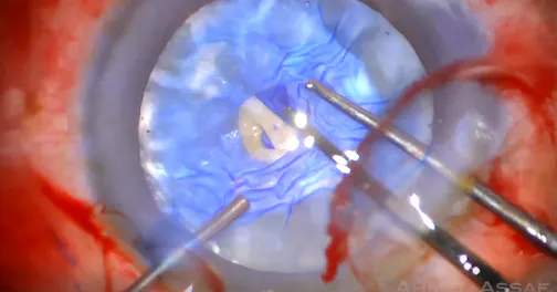 White Cataract With Fibrosis