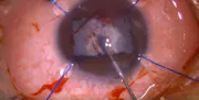 Subcapsular Plaque