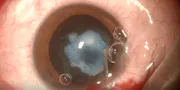 Posterior Capsular Plaque